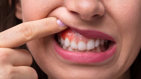 Causas de la inflamación gingival