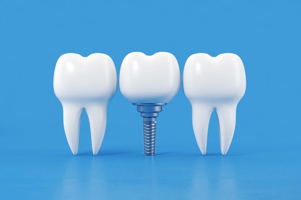 Cuánto tiempo dura un implante dental