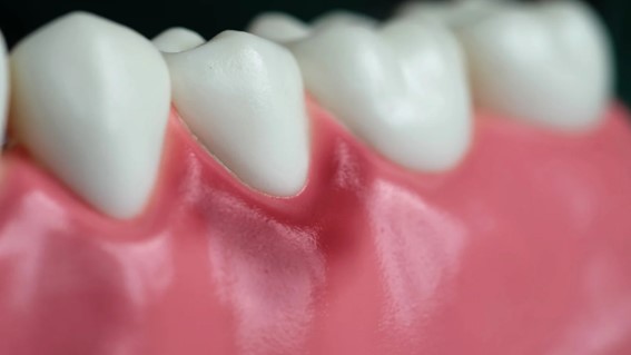 Qué pasa si no se tratan las encías inflamadas