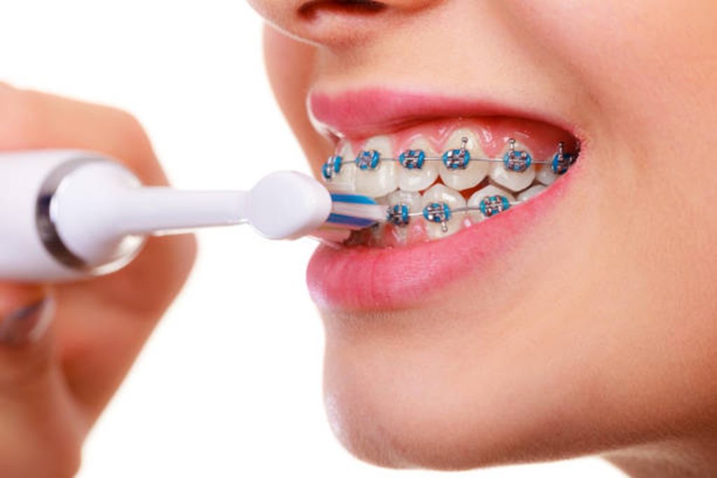 Cepillado con ortodoncia